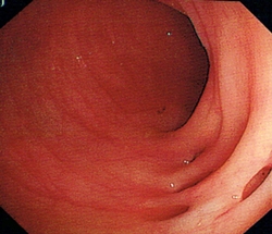 Inside of a normal bowel